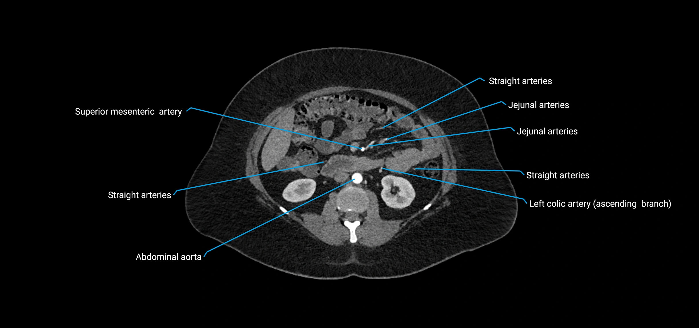 CTA abdomen axial cross sectional anatomy labelled image_86 (2).webp